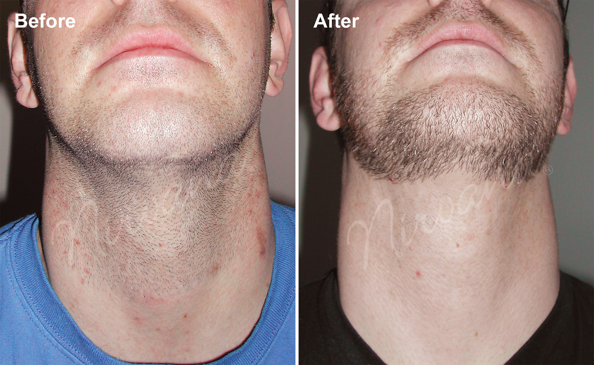 Minoxidil For Beard Before And After : Before Body Contouring ...
