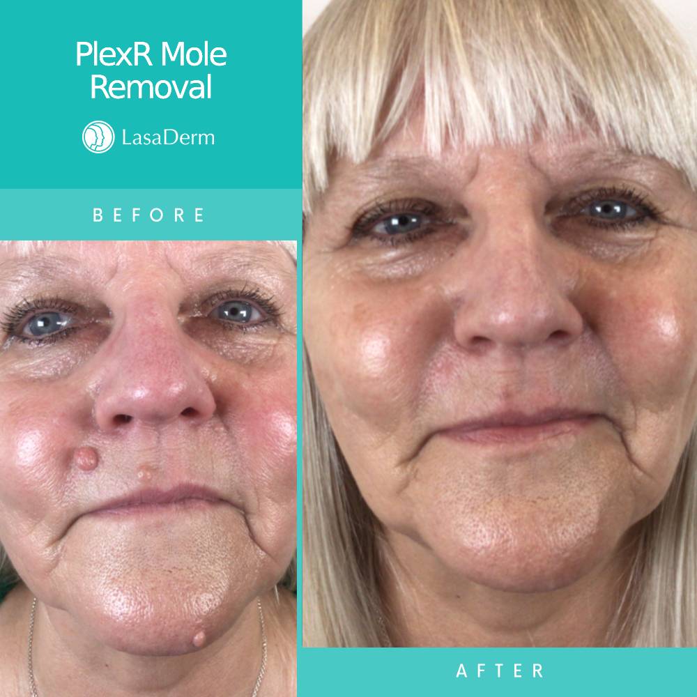 facial-mole-removal-using-plexr-lasaderm