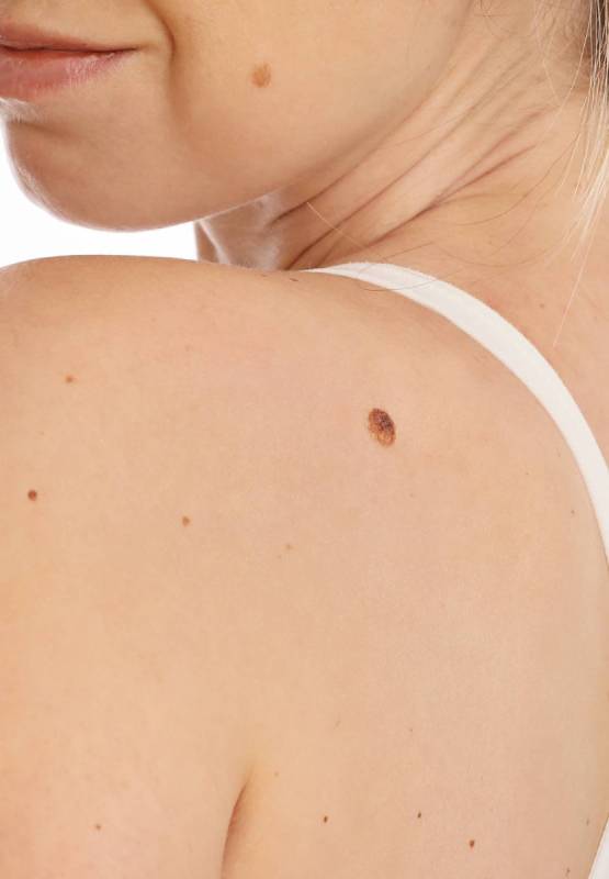 Moles, Cysts & Skin Tags