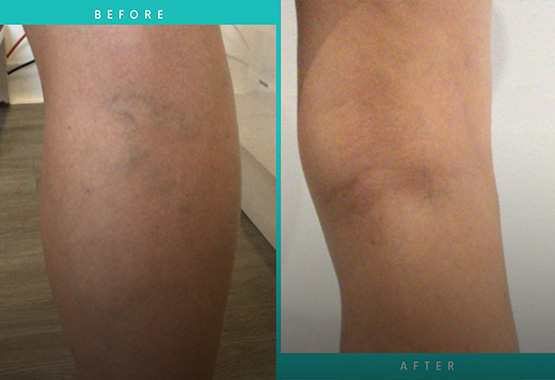 Susan's Foam Sclerotherapy