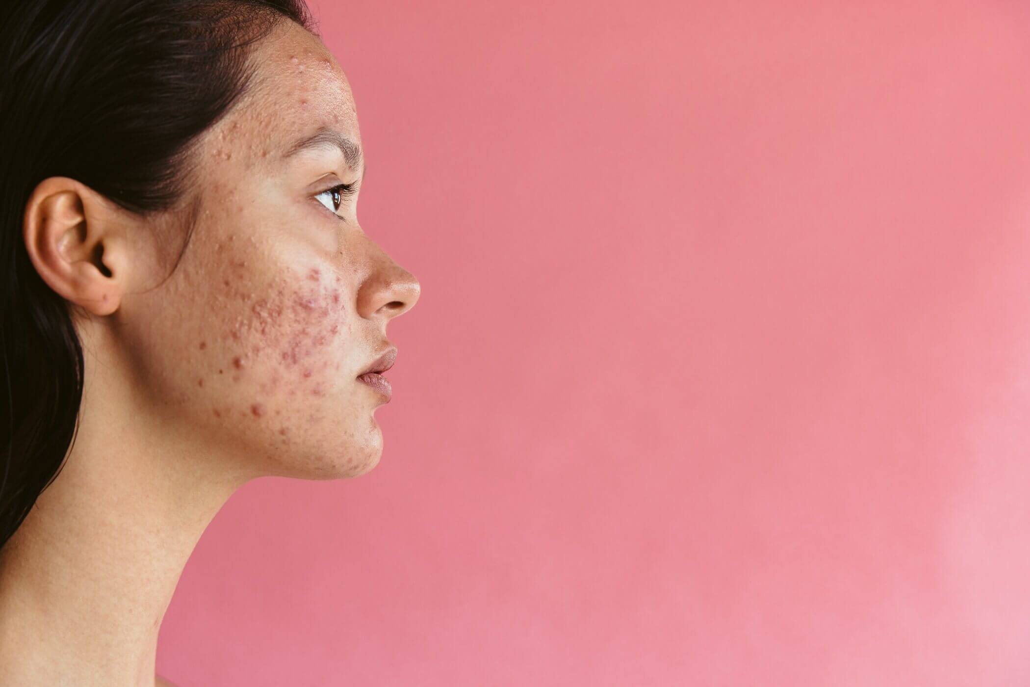 What Is The Best Acne Treatment?