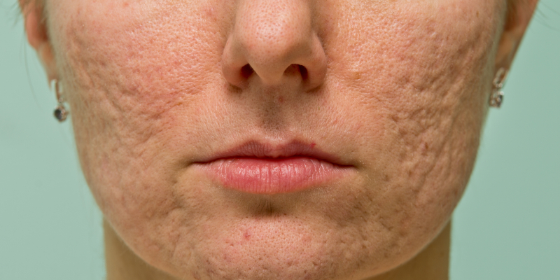 Acne scarring jaw