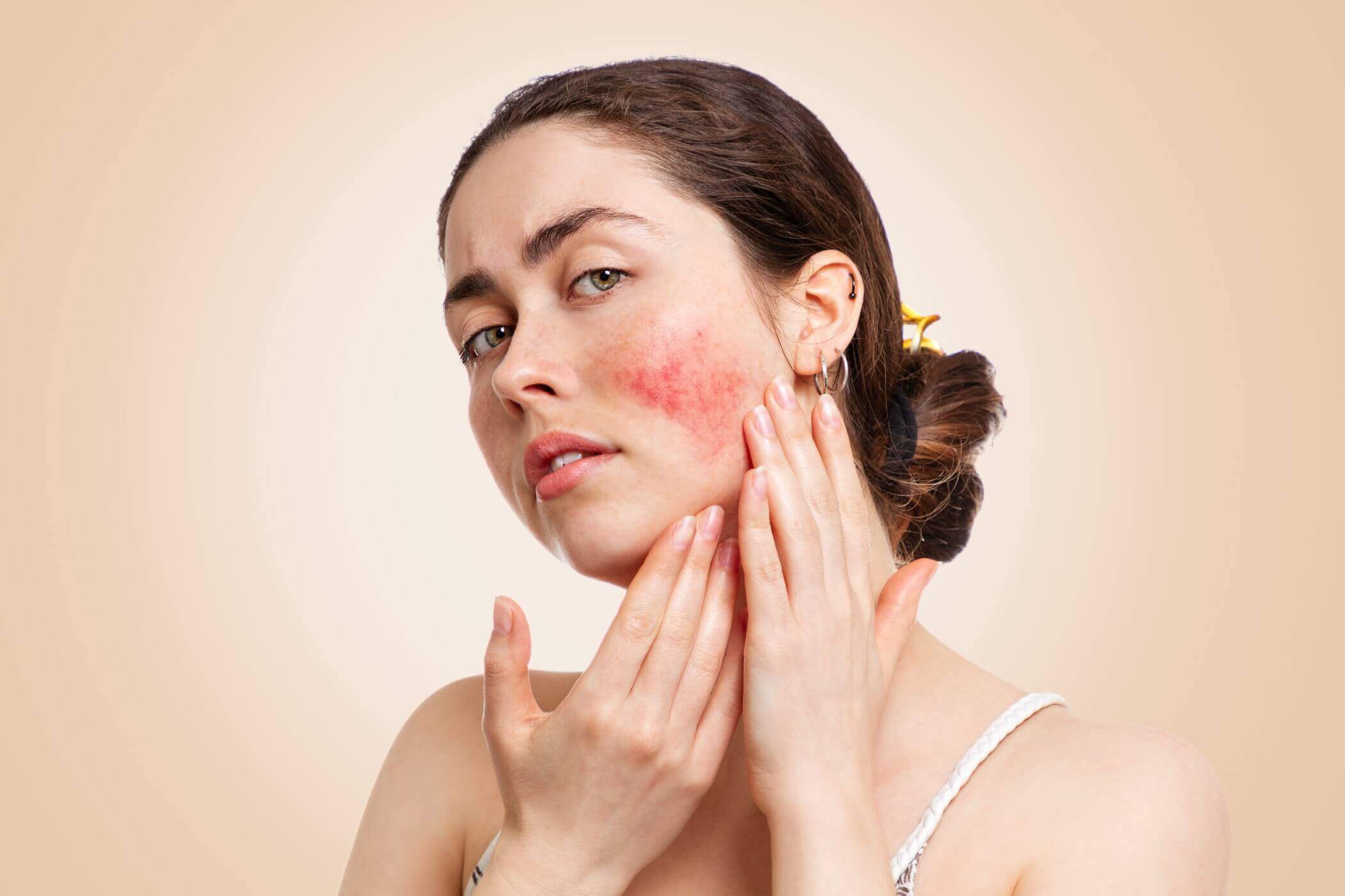 What Is Rosacea?