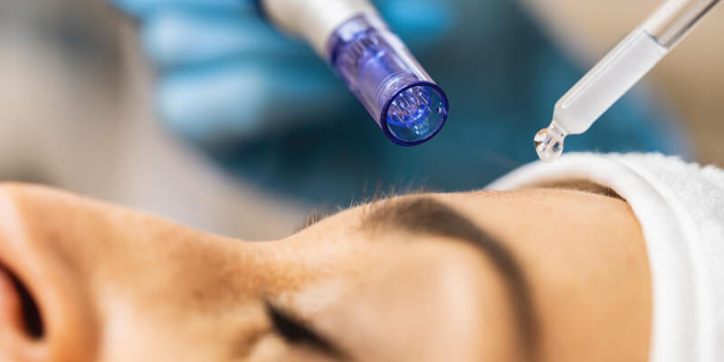 PRP Microneedling