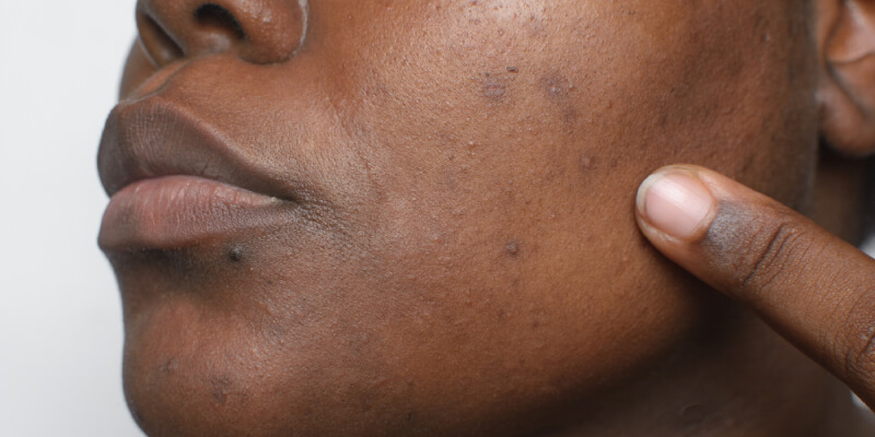 Signs of dull skin